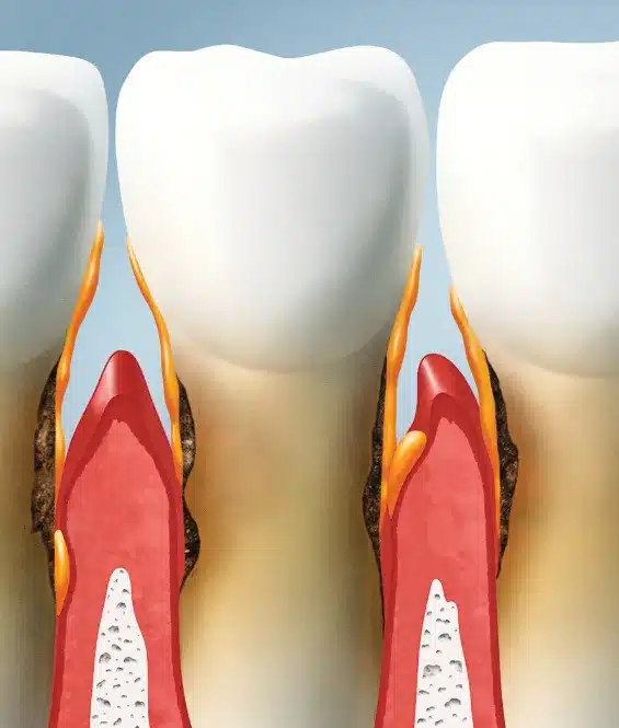 Periodontal Therapy