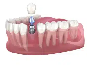 Single Implants