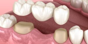 Missing teeth