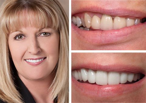 Before and after cosmetic dentistry showing restored teeth color and alignment at The Center for Cosmetic and Restorative Dentistry in Chesapeake, VA.