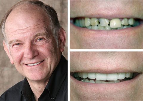Before and after dental restoration showing improved smile with cosmetic and restorative dentistry in Chesapeake, VA.