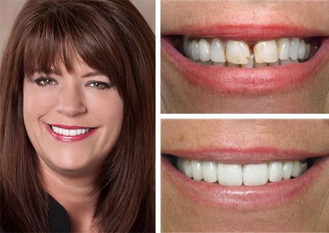 Before and after cosmetic dental treatment showing closed tooth gap and improved smile by cosmetic dentist in Chesapeake, VA.