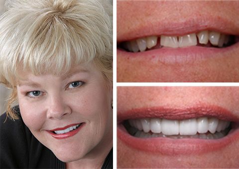 Before and after cosmetic dental restoration showing enhanced smile results from The Center for Cosmetic and Restorative Dentistry in Chesapeake, VA.