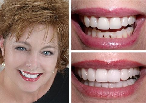 Before and after cosmetic dentistry showing enhanced smile with porcelain veneers and restorative treatment in Chesapeake, VA.