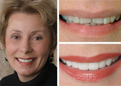 Before and after smile restoration showing cosmetic dental improvements with veneers and crowns in Chesapeake, VA.