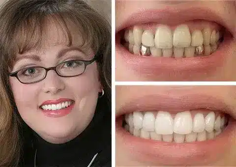 Expert-cosmetic-dentist-chesapeake-virginia Before and after smile makeover showing replacement of metal fillings with natural-looking restorations by cosmetic dentist in chesapeake, va.