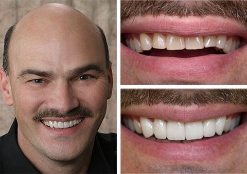 Before and after cosmetic dental restoration showing improved teeth alignment and color from expert cosmetic dentistry in Chesapeake, VA.