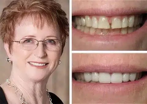 Before and after cosmetic dental restoration showing repaired chipped teeth and improved smile in Chesapeake, VA.