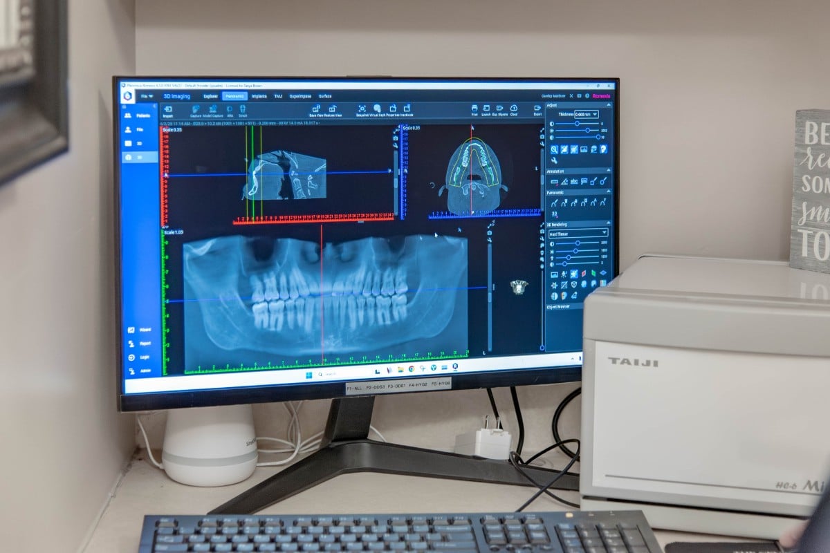 Digital dental x-rays displayed on a monitor at an expert dental office in chesapeake, virginia.