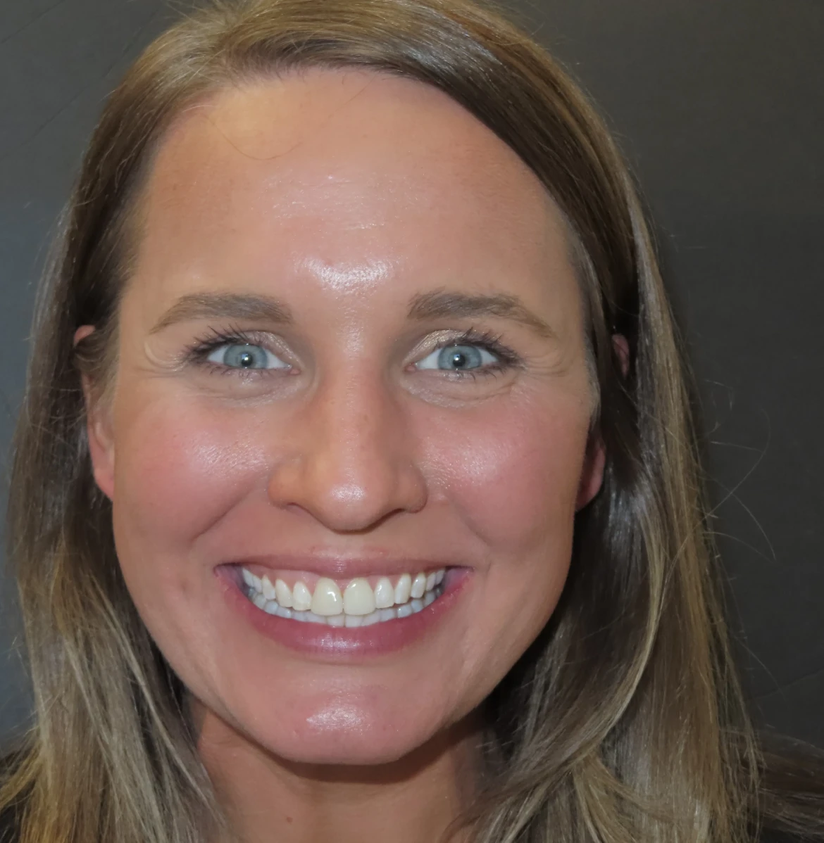 Smile before veneers showing discoloration and previous restorations