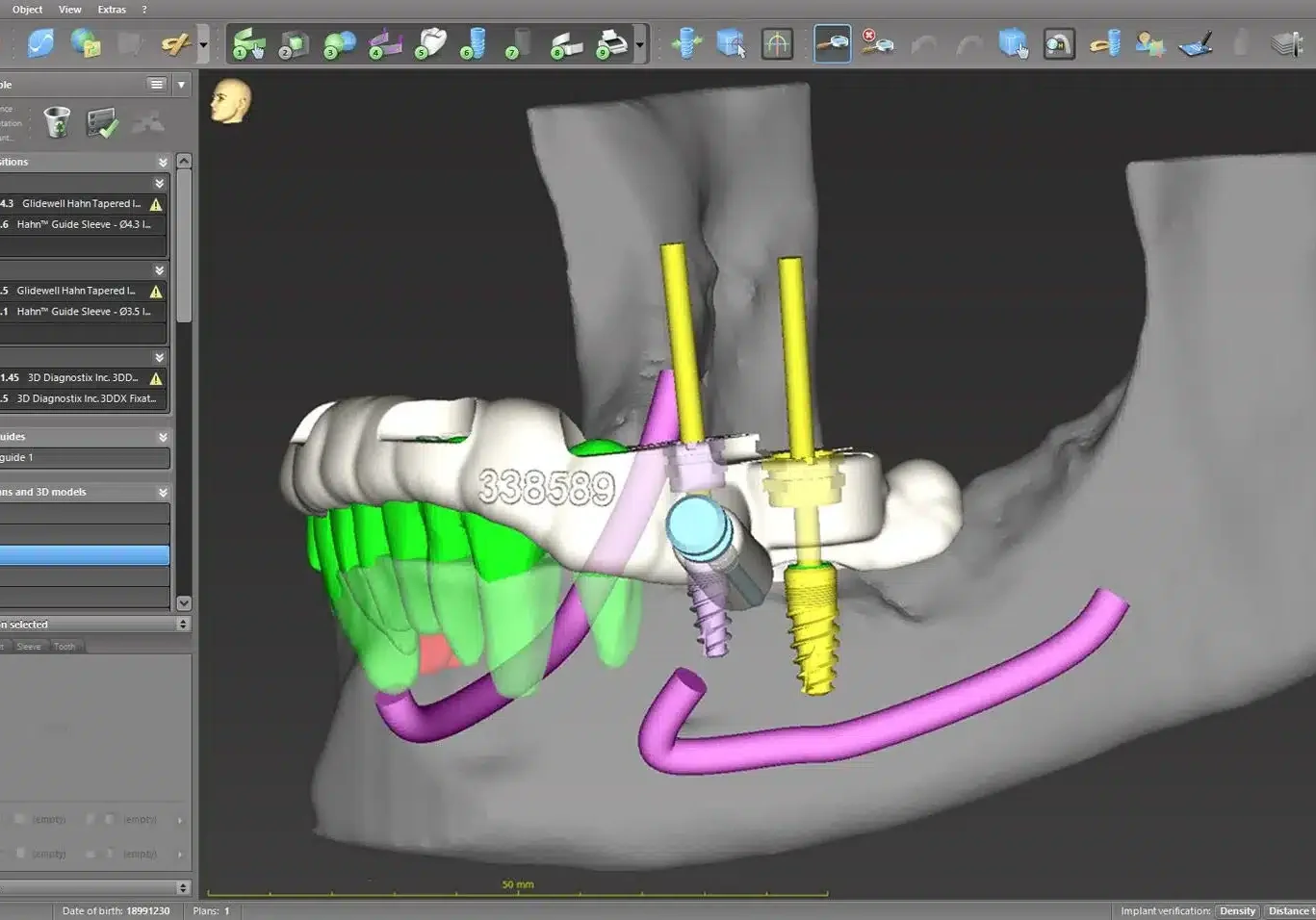 3-D Dental Implant Planning