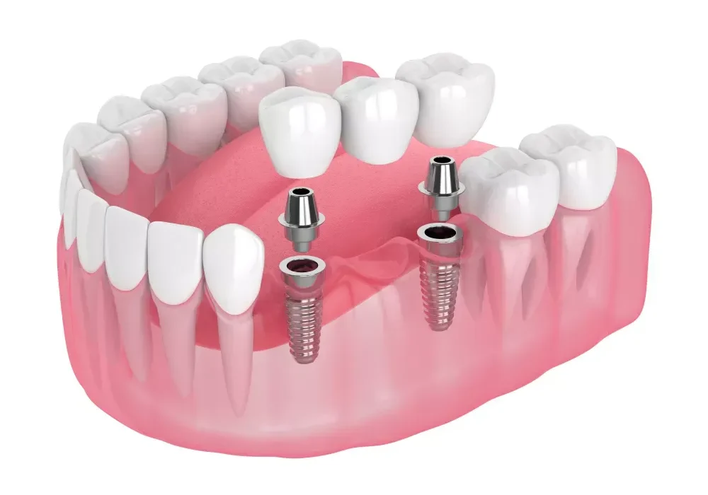 Implant-Supported Bridges